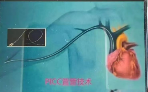 picc是什么意思(PICC定义)